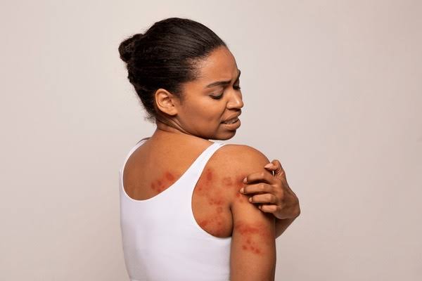 best cream for itchy skin rash
