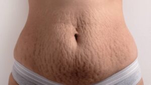 body lotion to reduce stretch marks