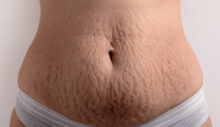 body lotion to reduce stretch marks