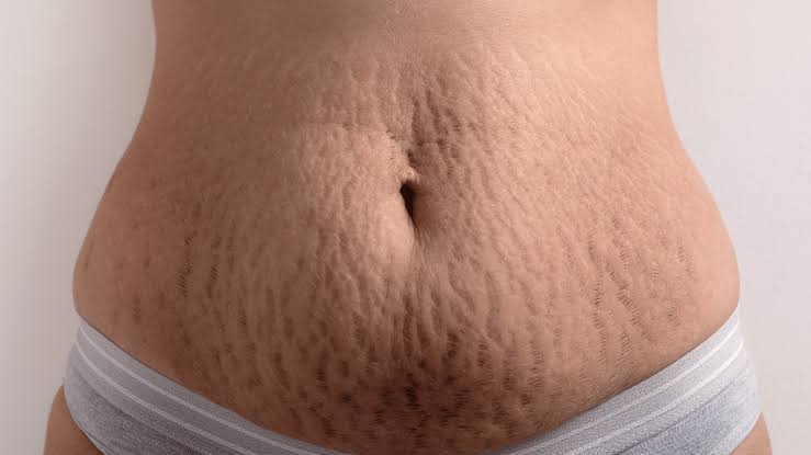 body lotion to reduce stretch marks